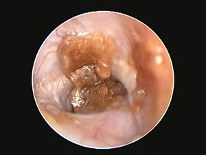 ビデオオトスコープでの治療前の耳道