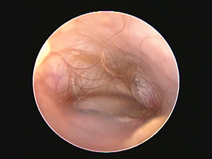 治療後の耳道と鼓膜